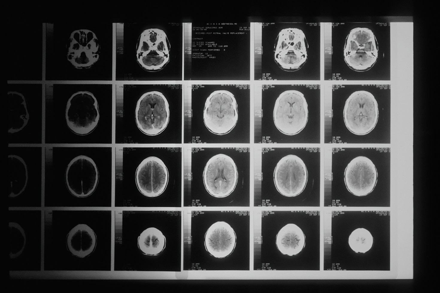 Zrozumieć neurobiologię zmian zachodzących pod wpływem psychodelików
